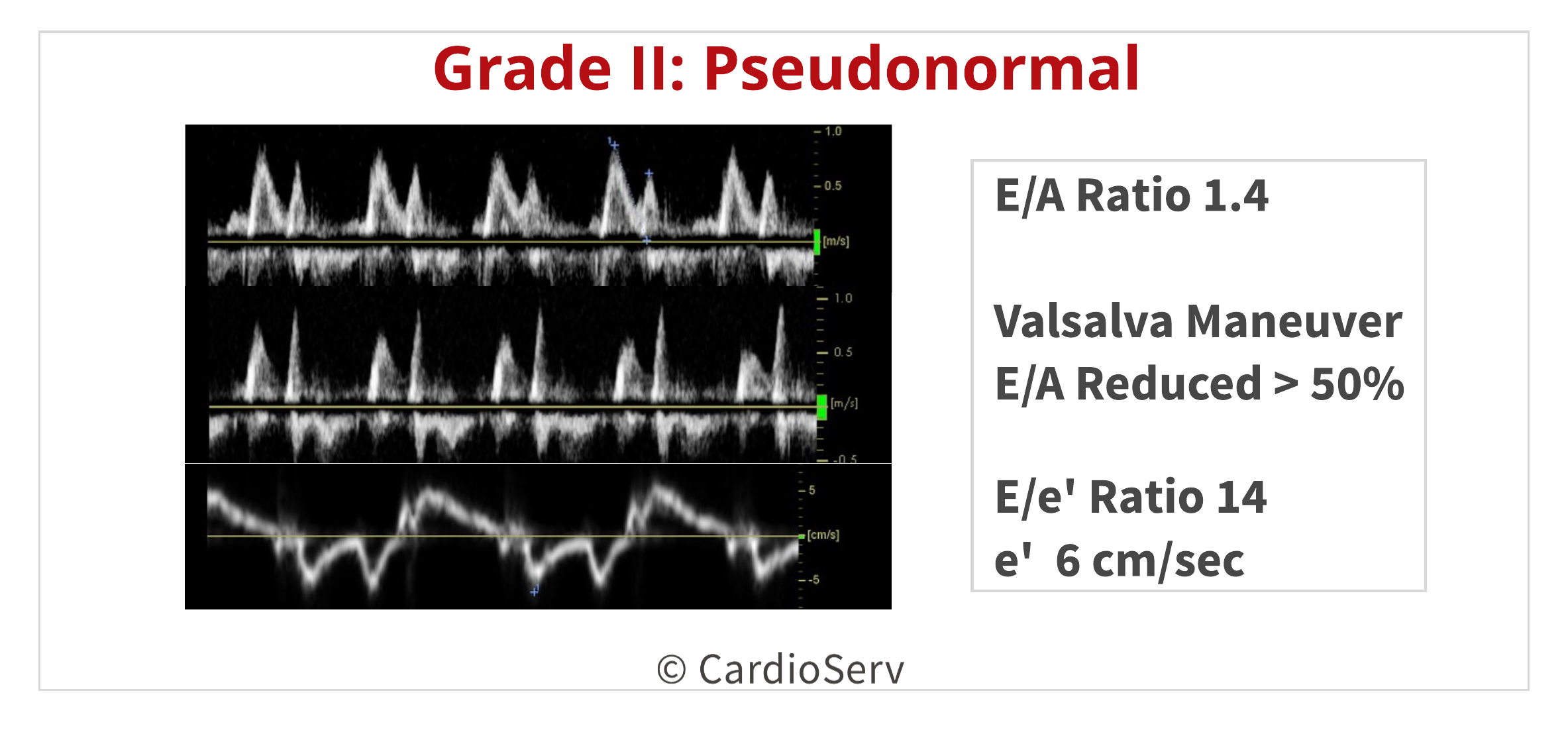 Diastolic Dysfunction PseudonormalLV Filling Pattern Echo
