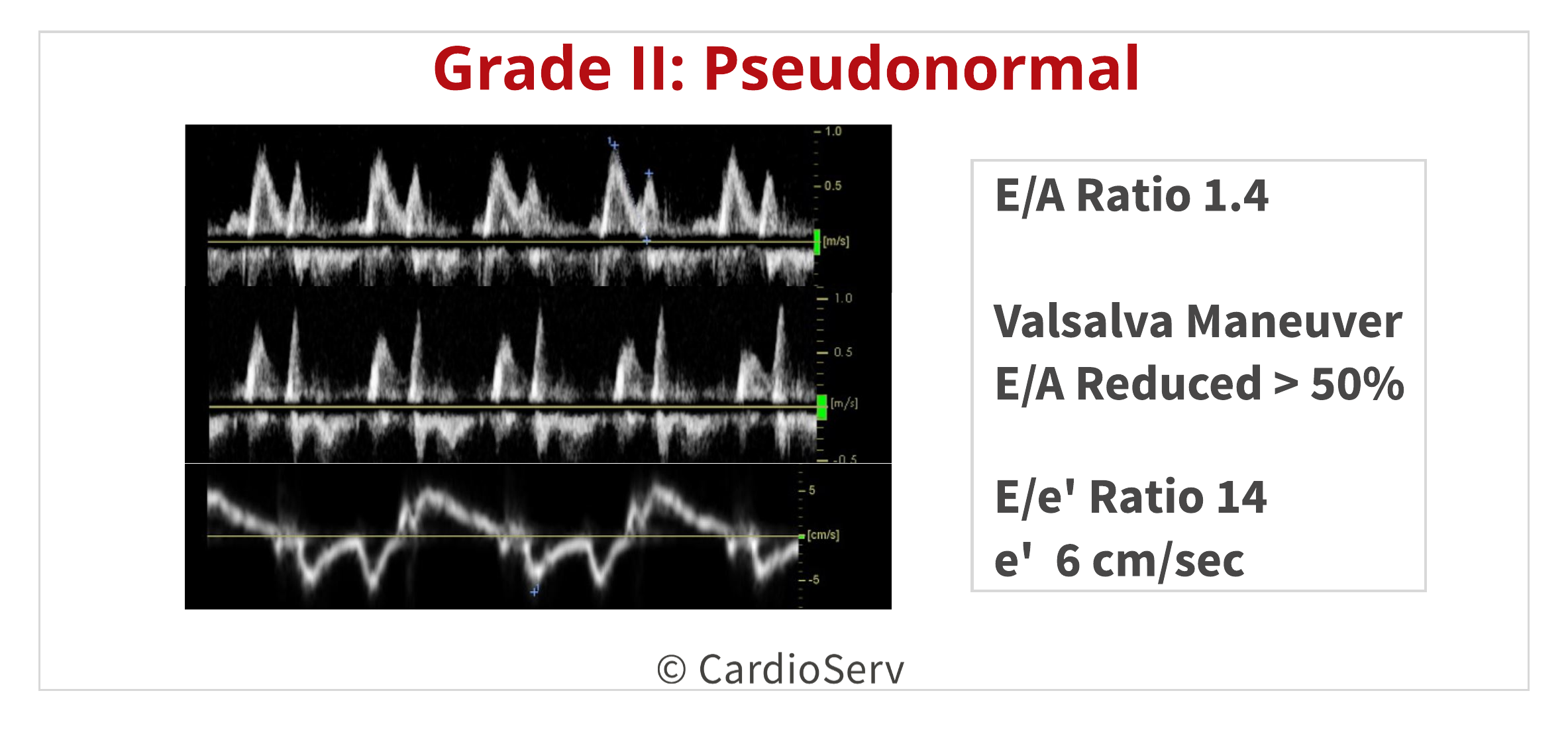 Understanding the Basics: LV Filling Patterns Cardioserv