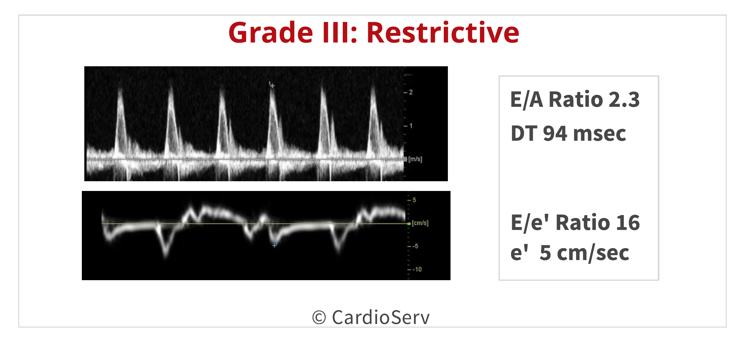 Diastolic Dysfunction Restrictive LV Filling Pattern Echo