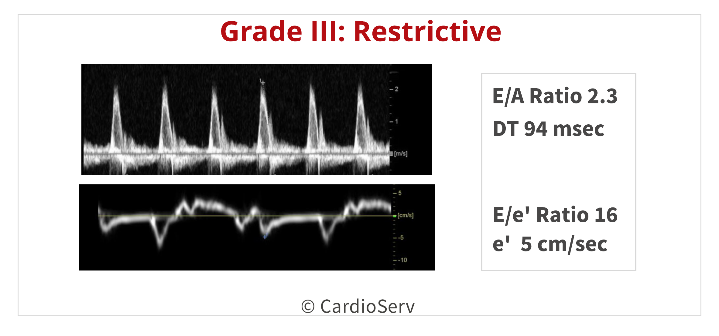 Understanding the Basics: LV Filling Patterns Cardioserv