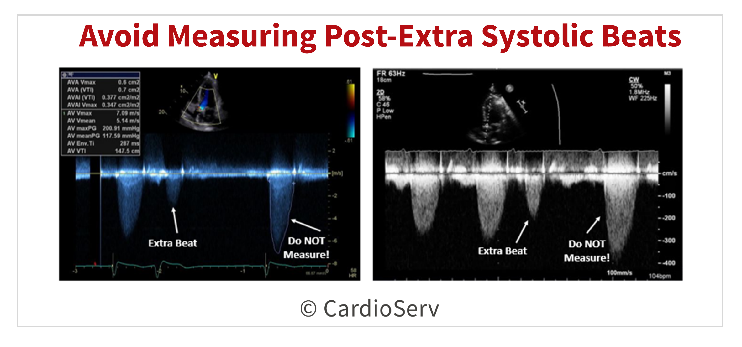 Avoid measuring post-extra systolic beats as peak AV velocity