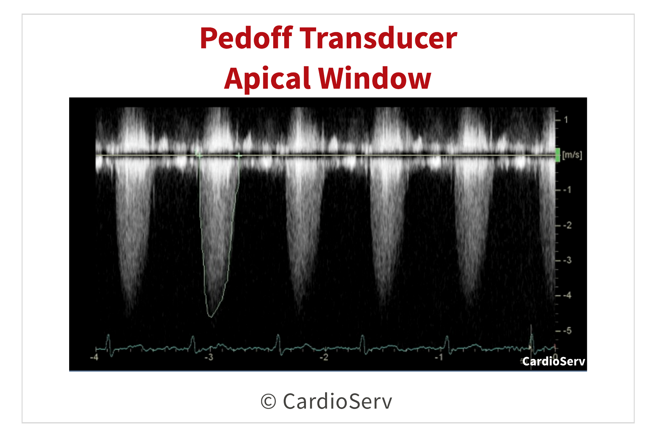 Pedoff Transducer Aortic Stenosis CW Doppler