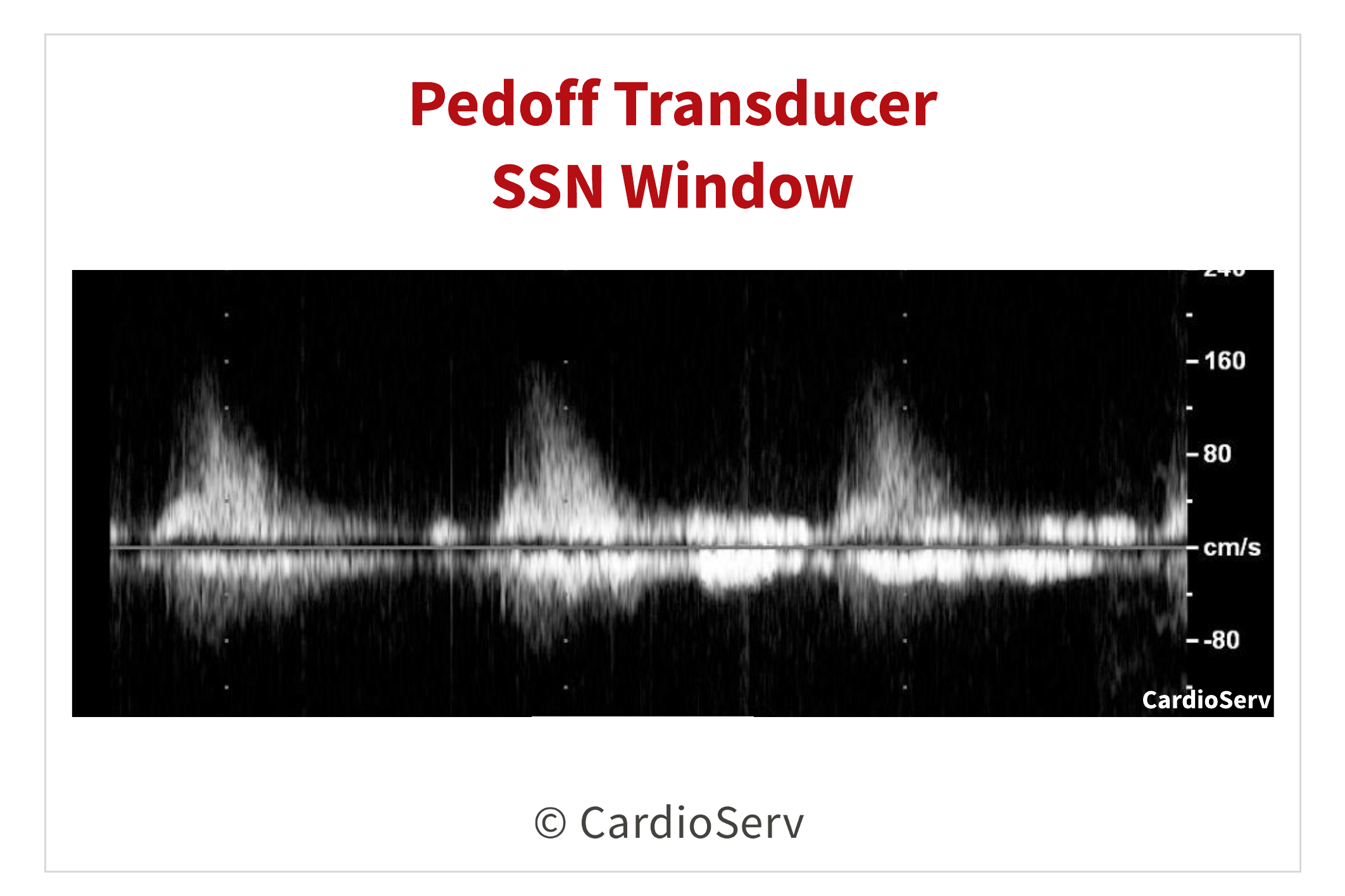 Pedoff Probe SSN Velocity Aortic Stenosis Echo