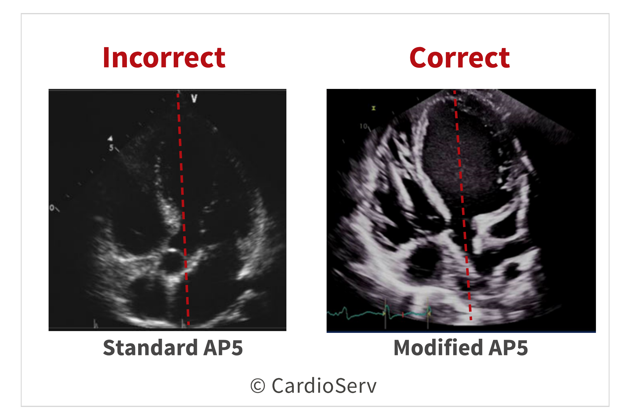 Modified Apical 5 Chamber Echo Aortic Valve Doppler