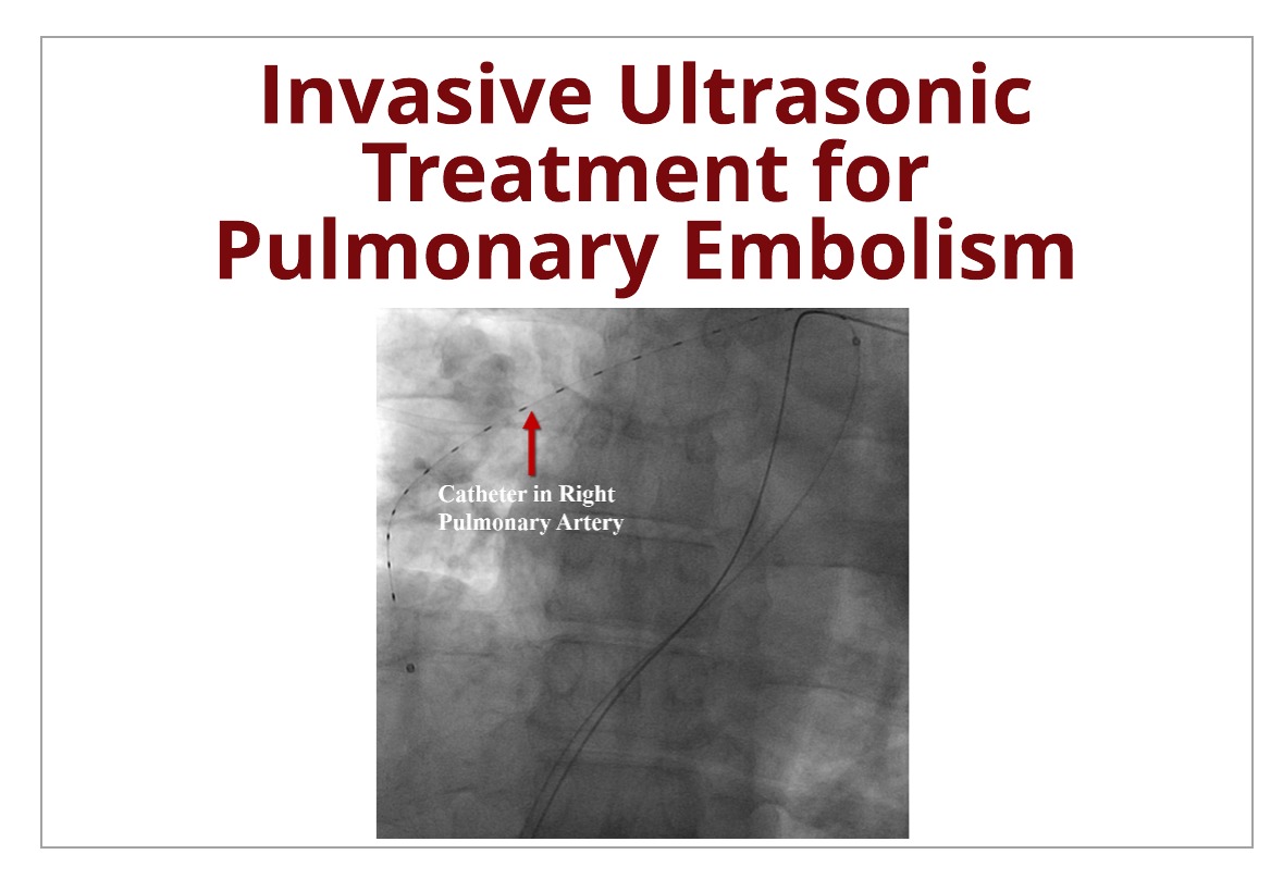 Invasive Ultrasonic Procedure to Treat Pulmonary Embolisms