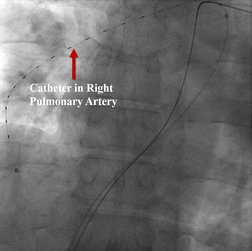 Invasive Cath Pulmonary Embolism EKOS