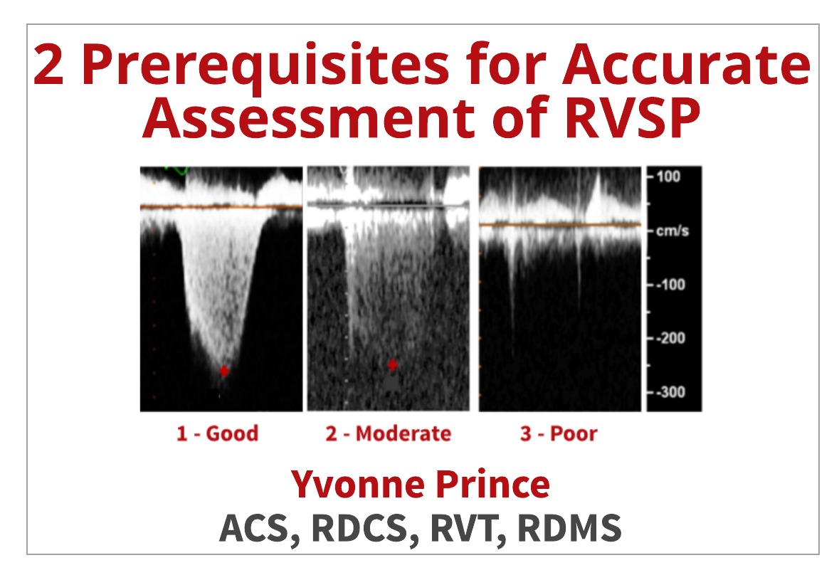 2 Ways to Properly Assess TR Jets for Accurate RVSP Calculations