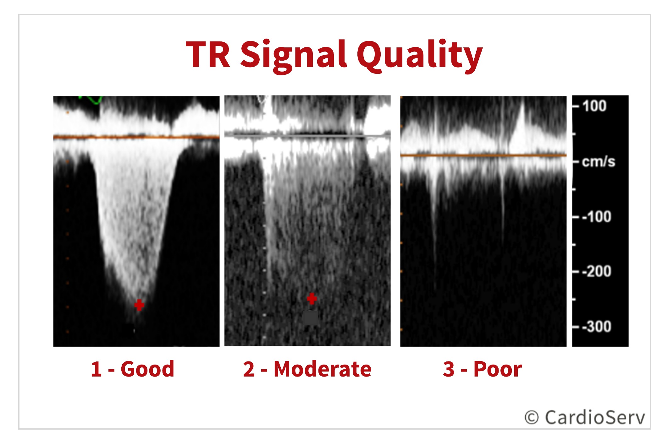 Grading Tricuspid Regurgitation TR Velocity Doppler Envelope 