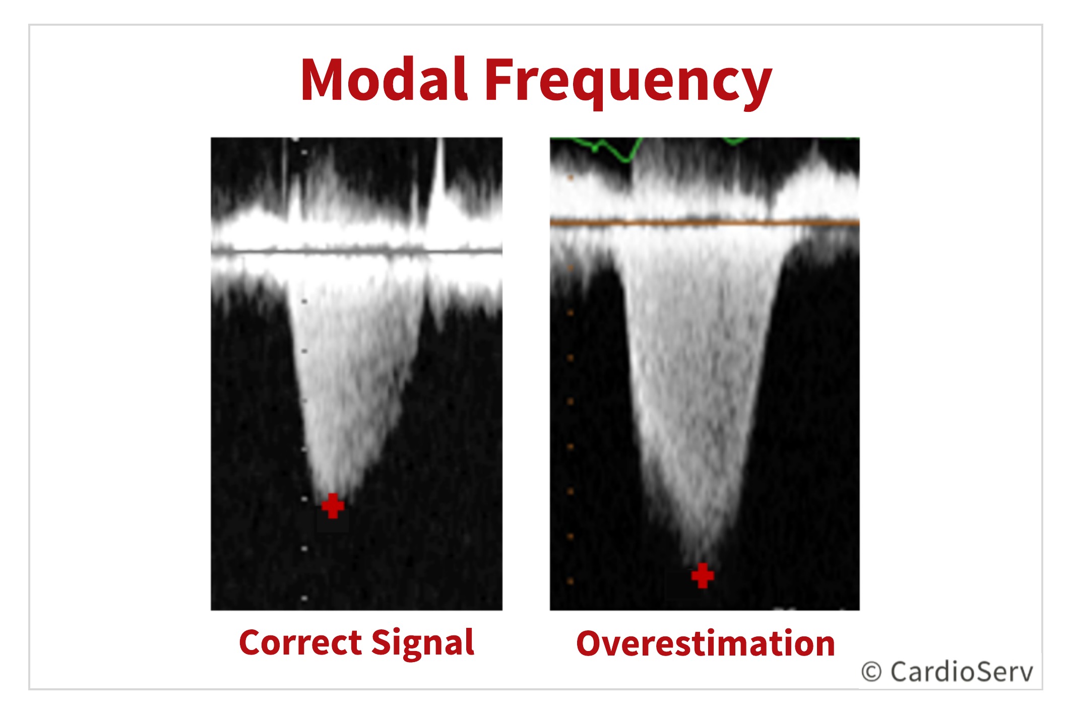 Modal Frequency of Tricuspid Regurgitation TR