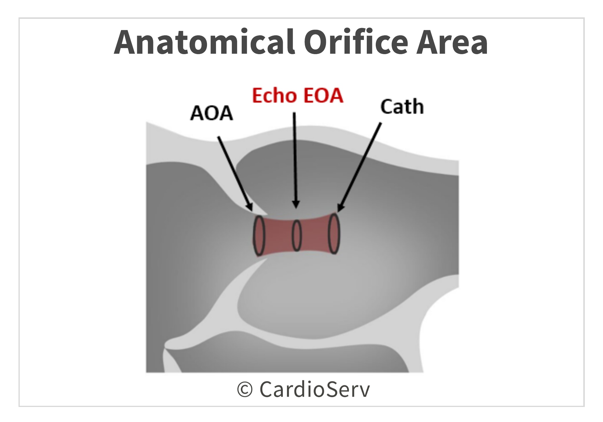 AOA Anatomical Orifice Area Aortic Valve Area AVA Planimetry Echo