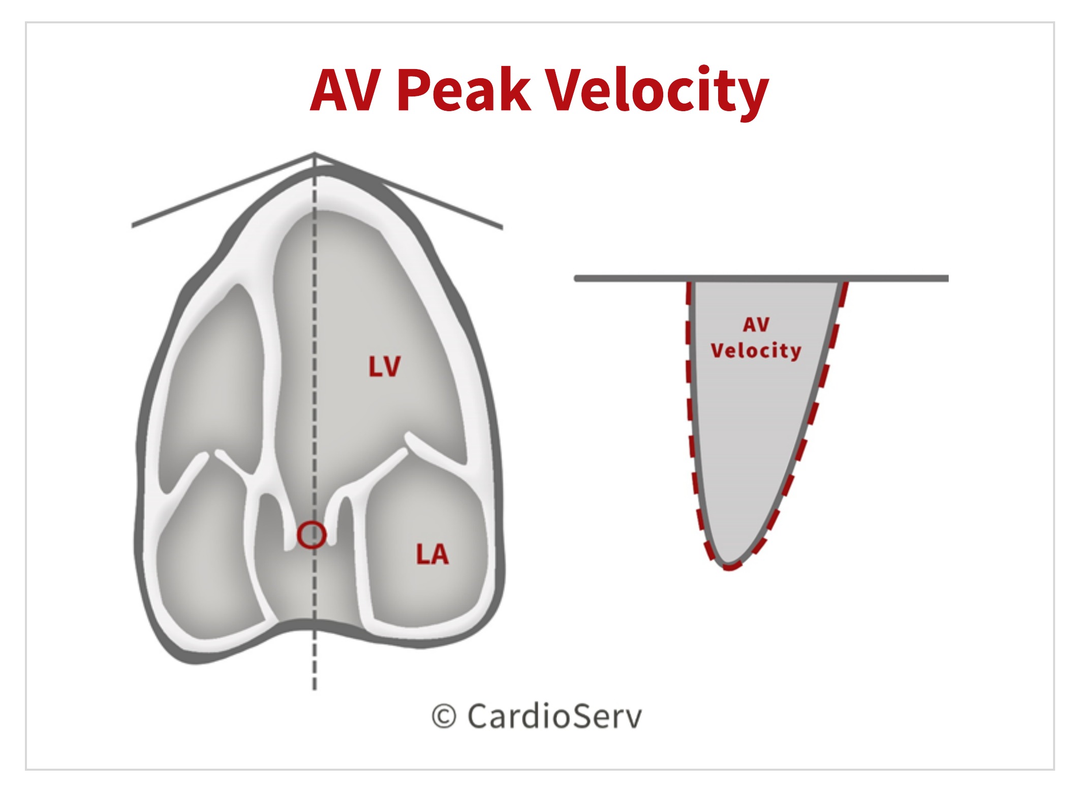 Specific Echo Parameters that Indicate Elevated LAP Cardioserv