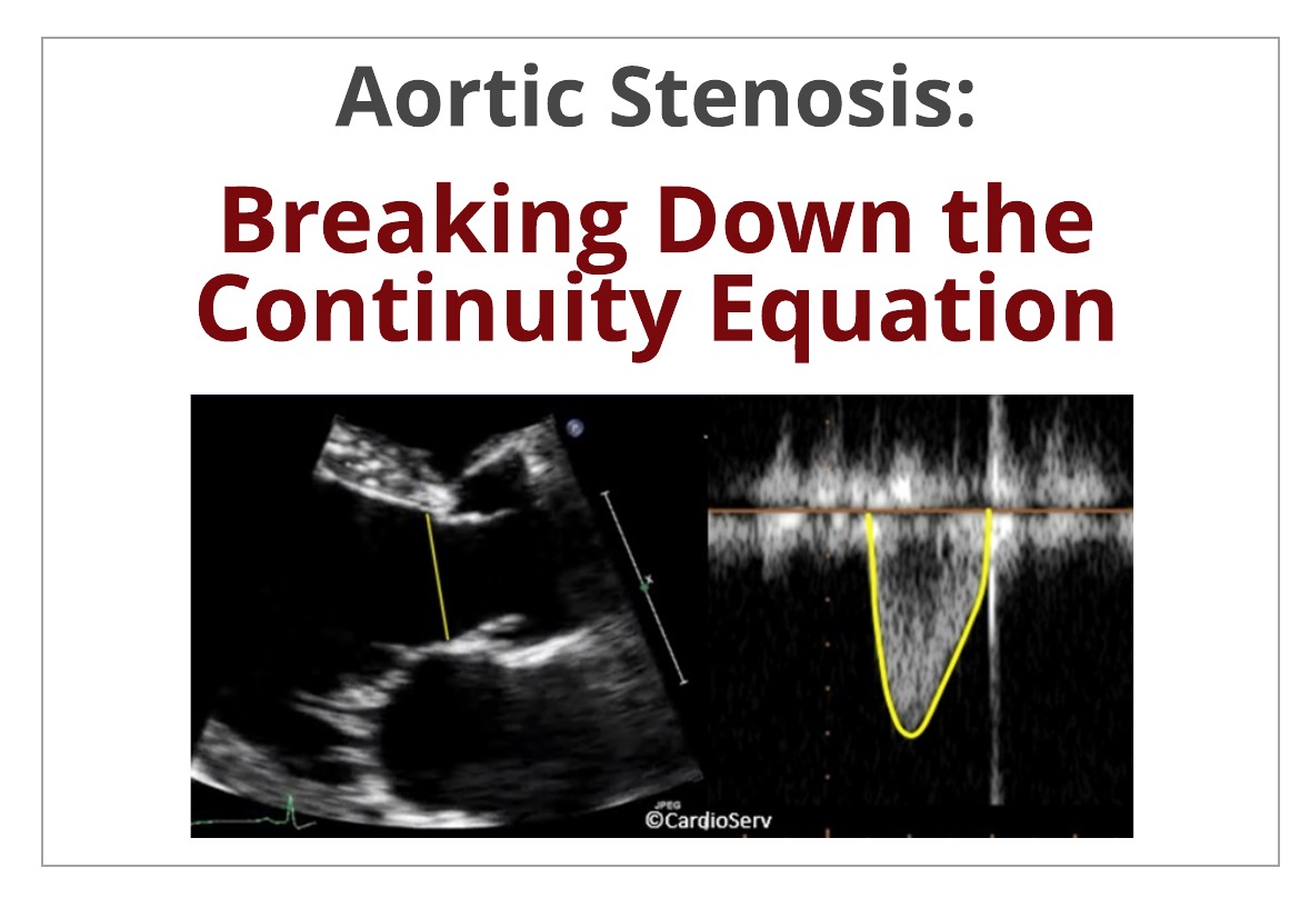 Aortic Stenosis: Breaking Down the Continuity Equation