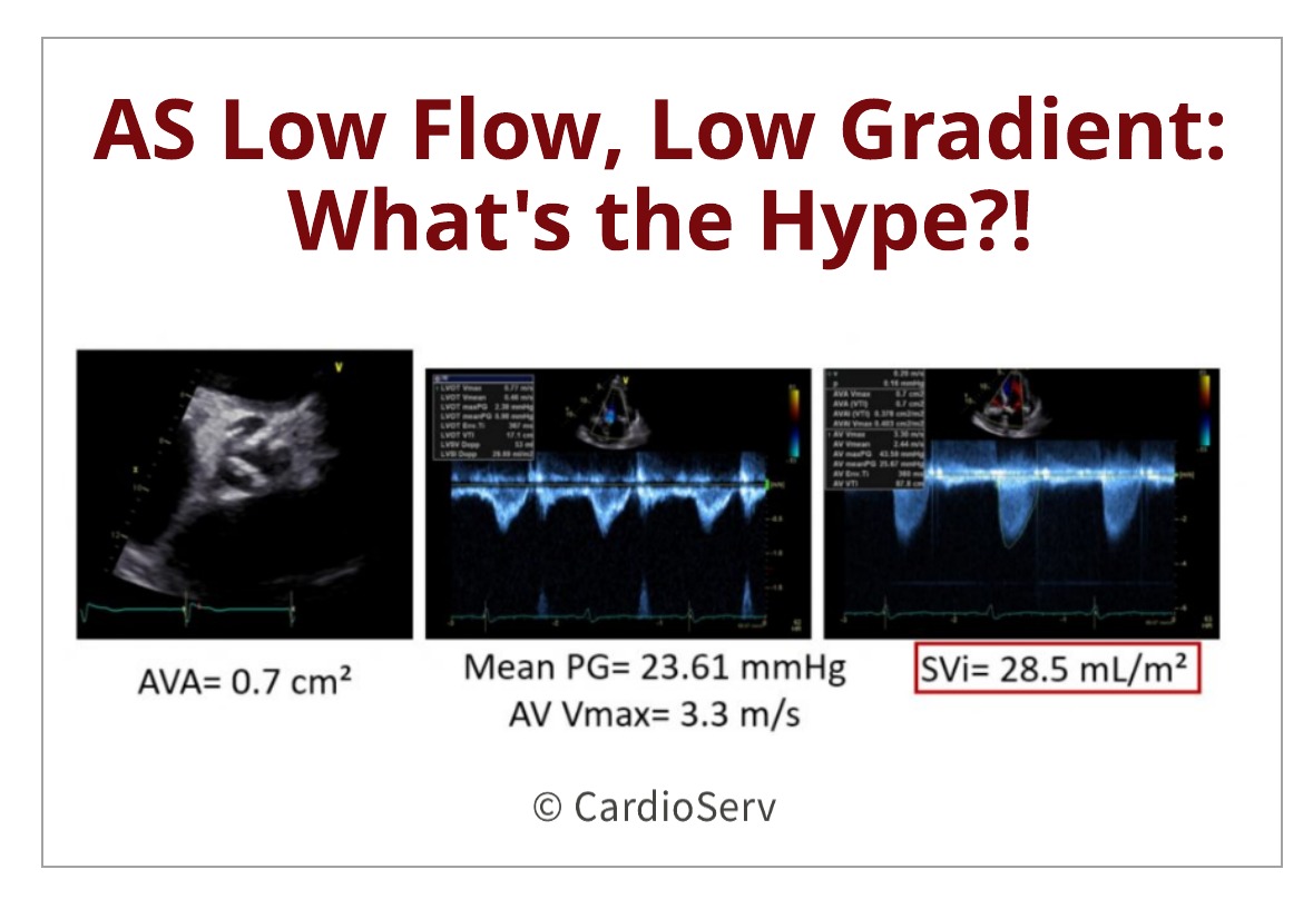 Aortic Stenosis Low Flow, Low Gradient: What’s the hype?!