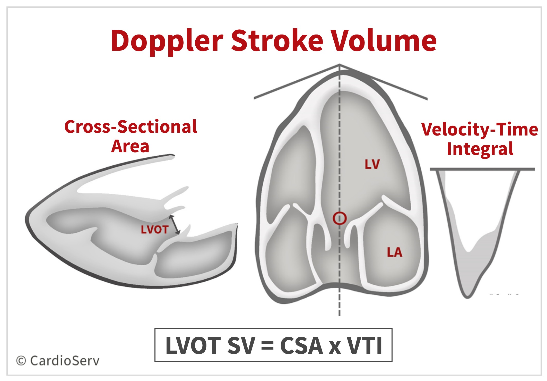 Doppler Stroke Volume Calculation 