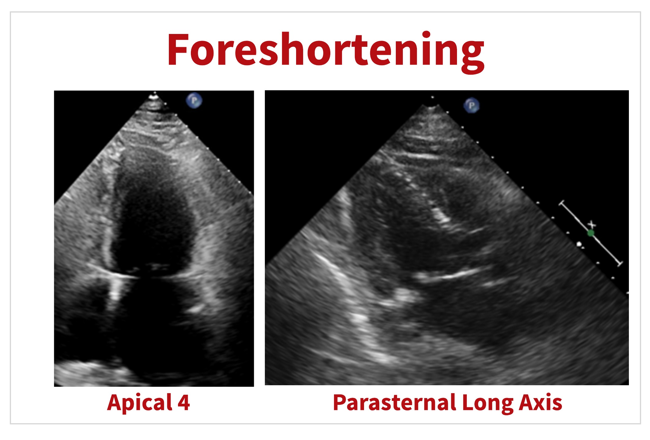 Foreshortening Echo