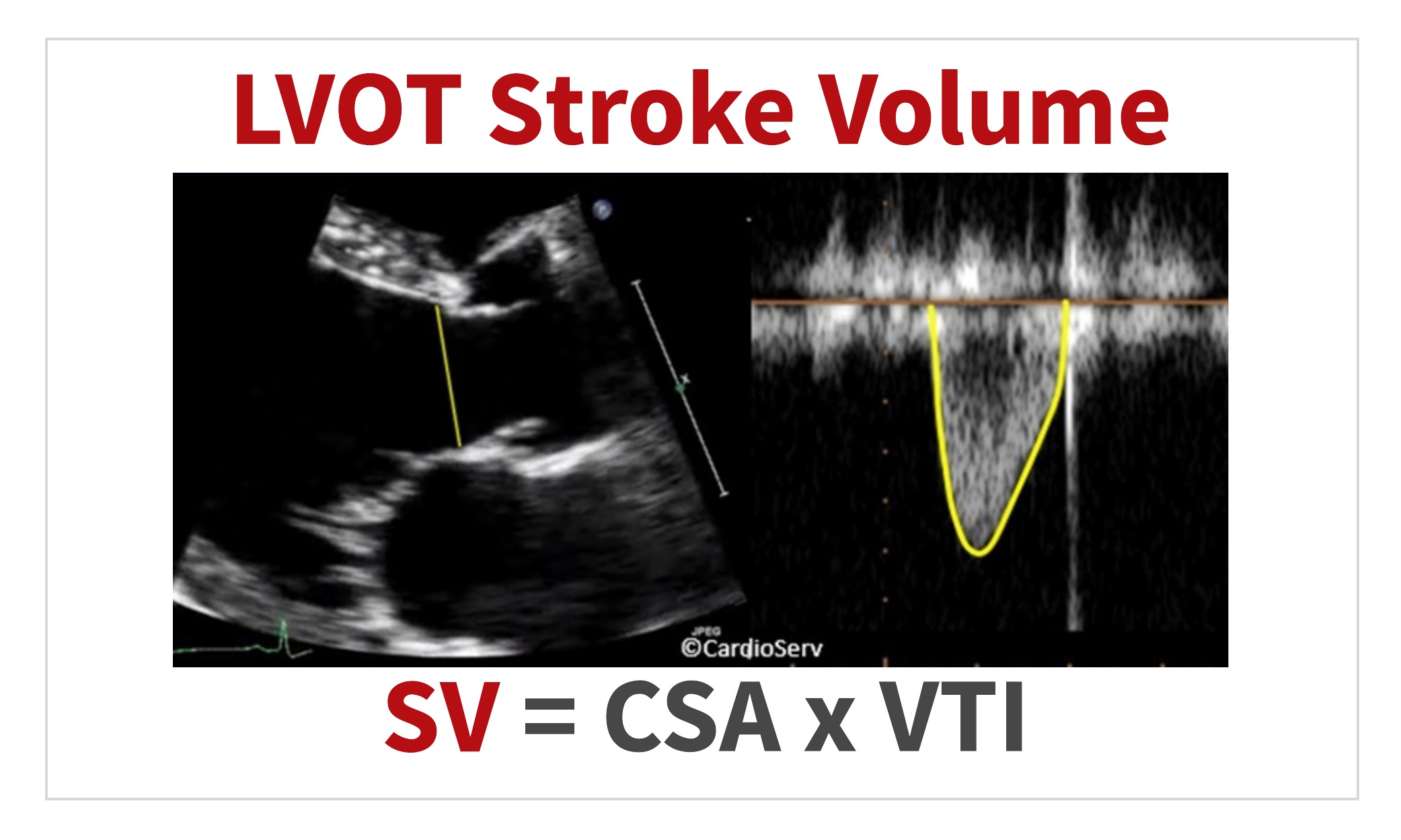 LVOT Stroke Volume 