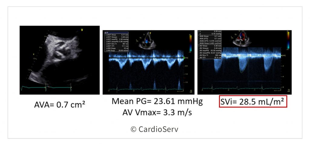 Low Flow Low Gradient Aortic Stenosis Echo