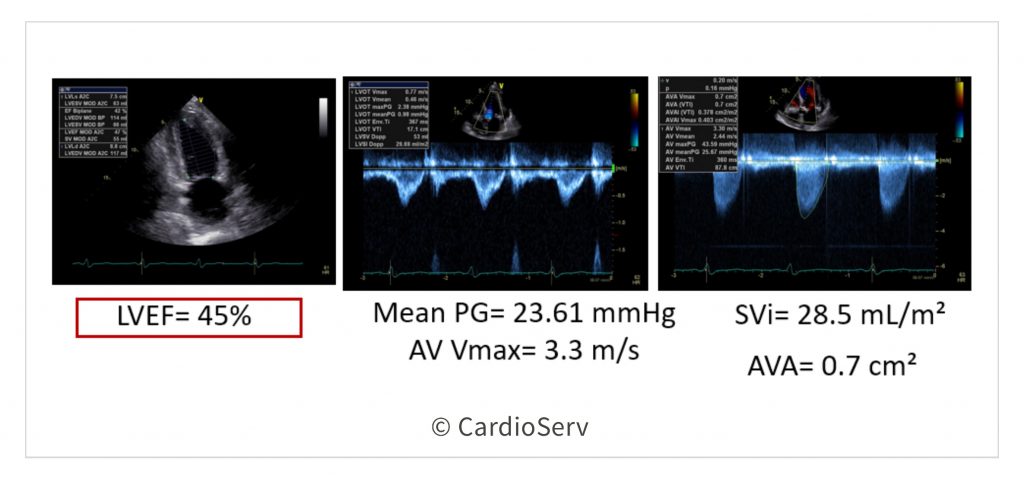 Low Flow Low Gradient Reduced EF Severe Aortic Stenosis Echo