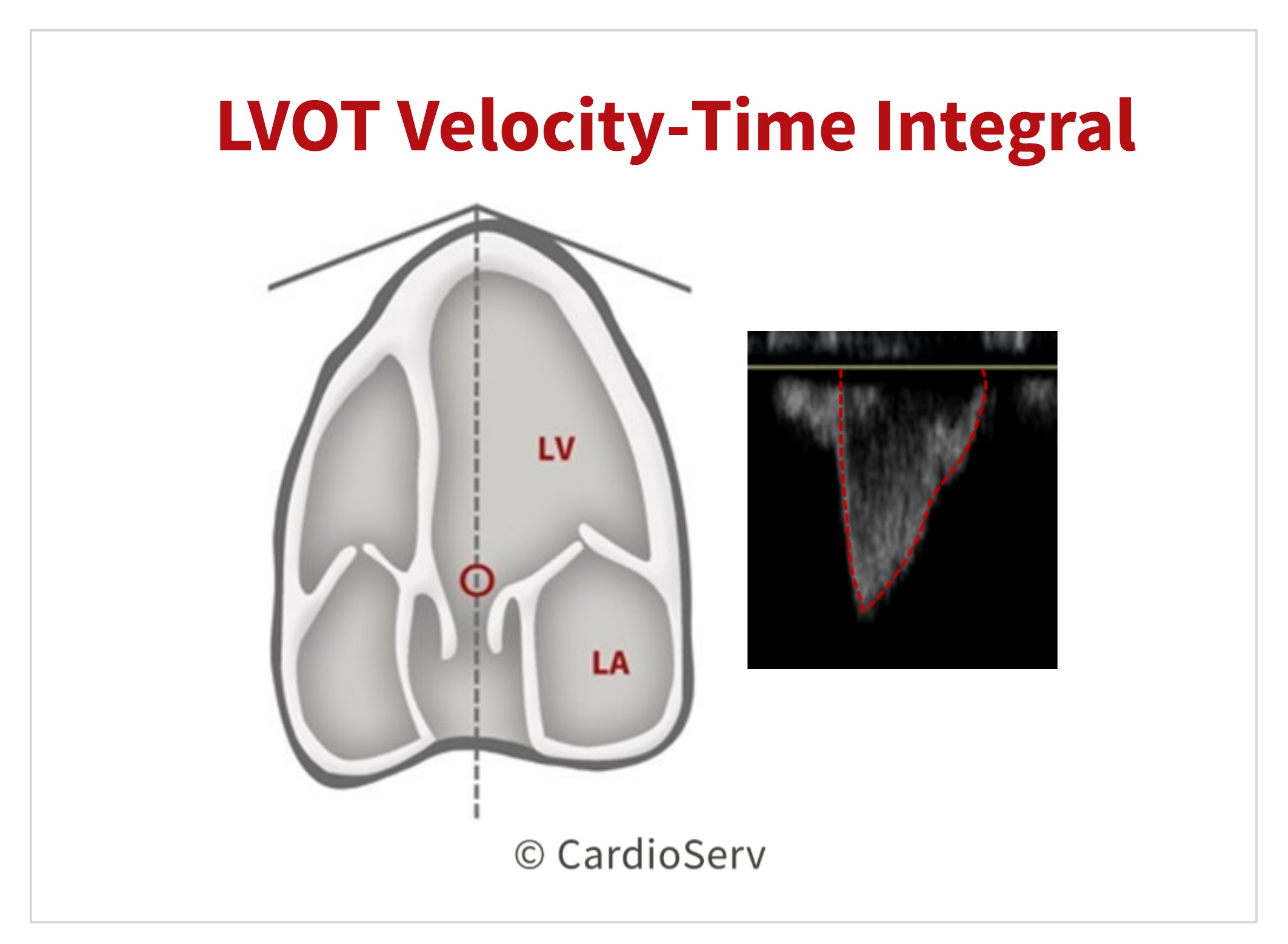 Specific Echo Parameters that Indicate Elevated LAP Cardioserv