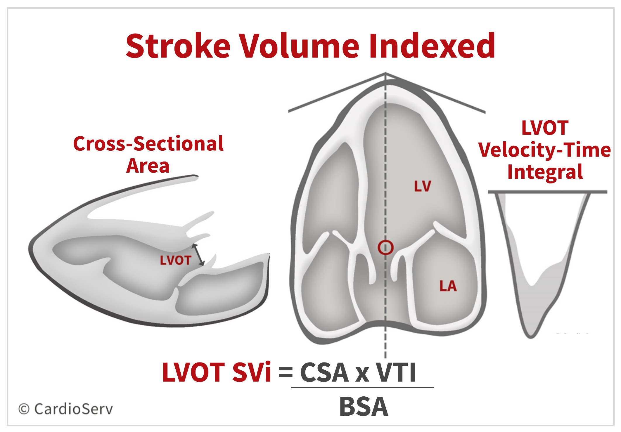 SVi Stroke Volume Index Aortic Stenosis Echo