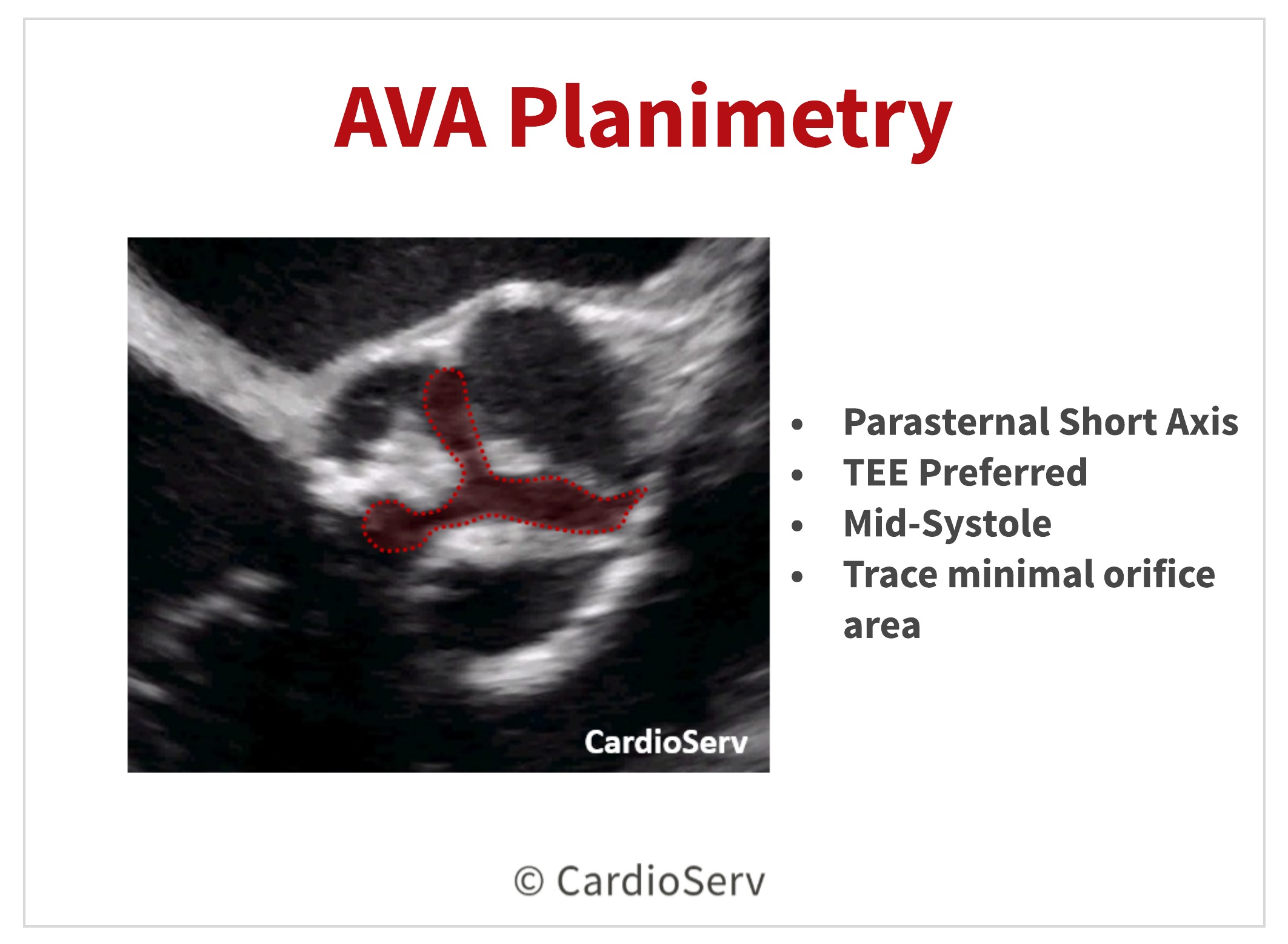 AVA Planimetry Echo Aortic Stenosis