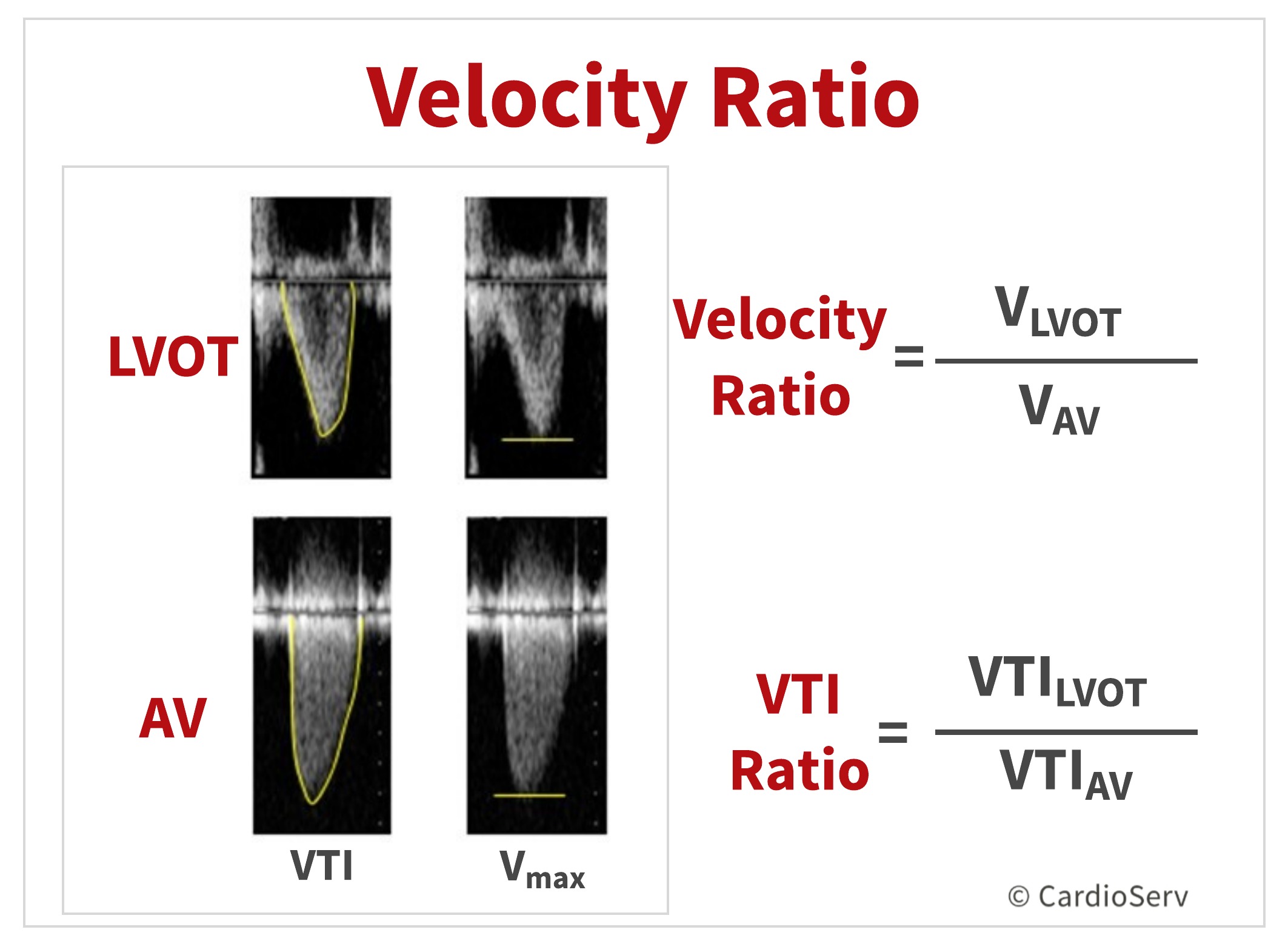 velocity ratio AVA aortic stenosis echo