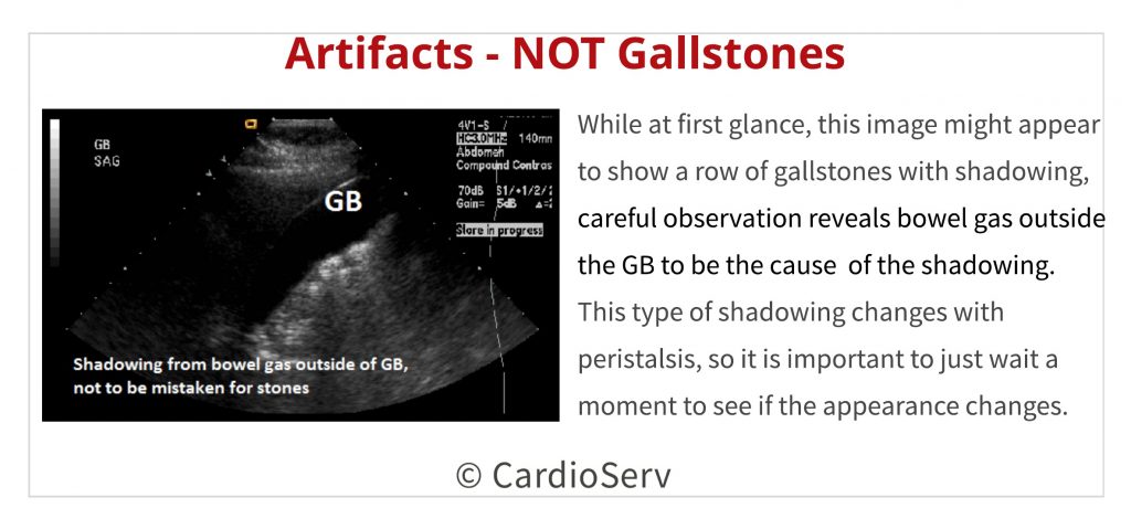 ultrasound artifact v gallstones