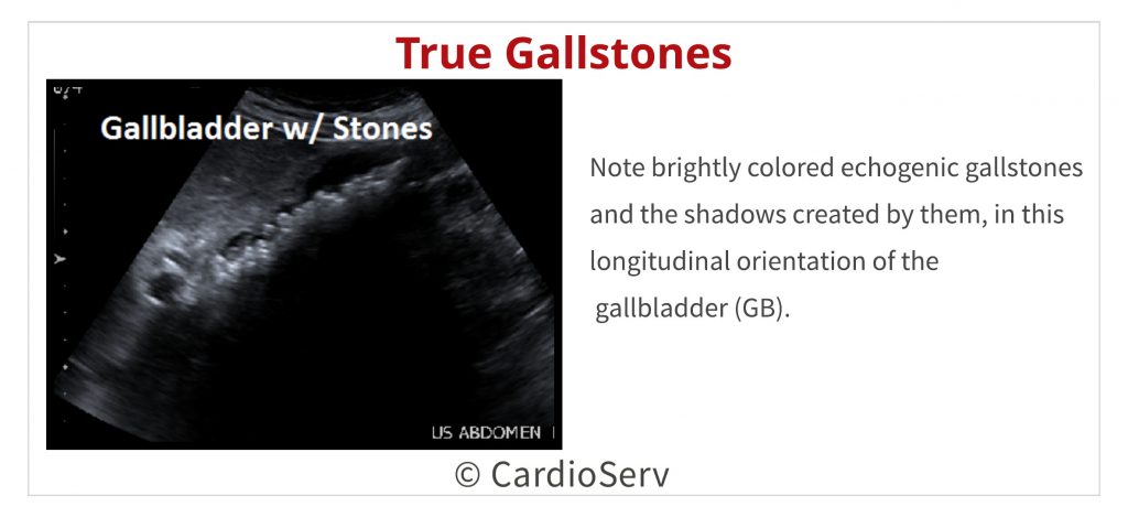 Abdominal ultrasound - Gallstones in gallbladder 