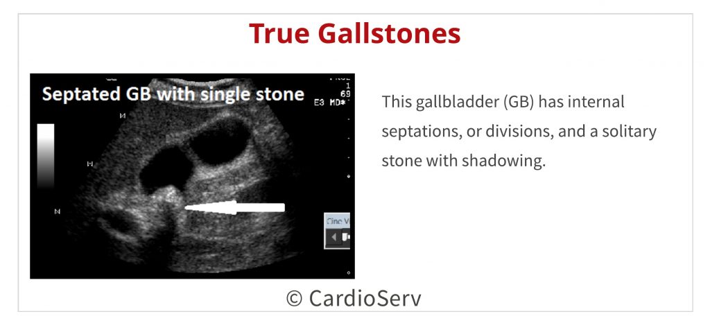 abdominal ultrasound - solitary stone