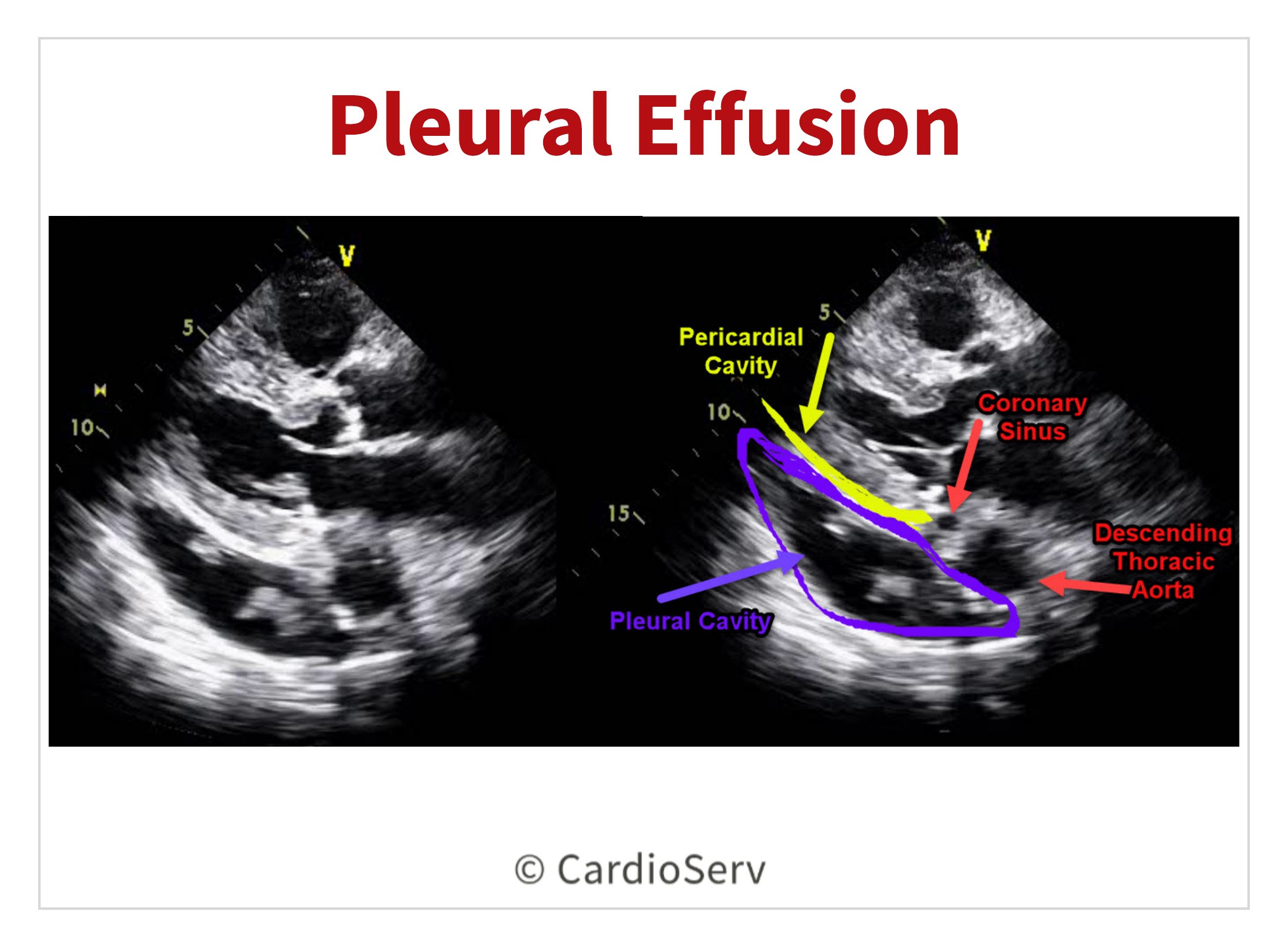 Pleural versus Pericardial Effusion Echo