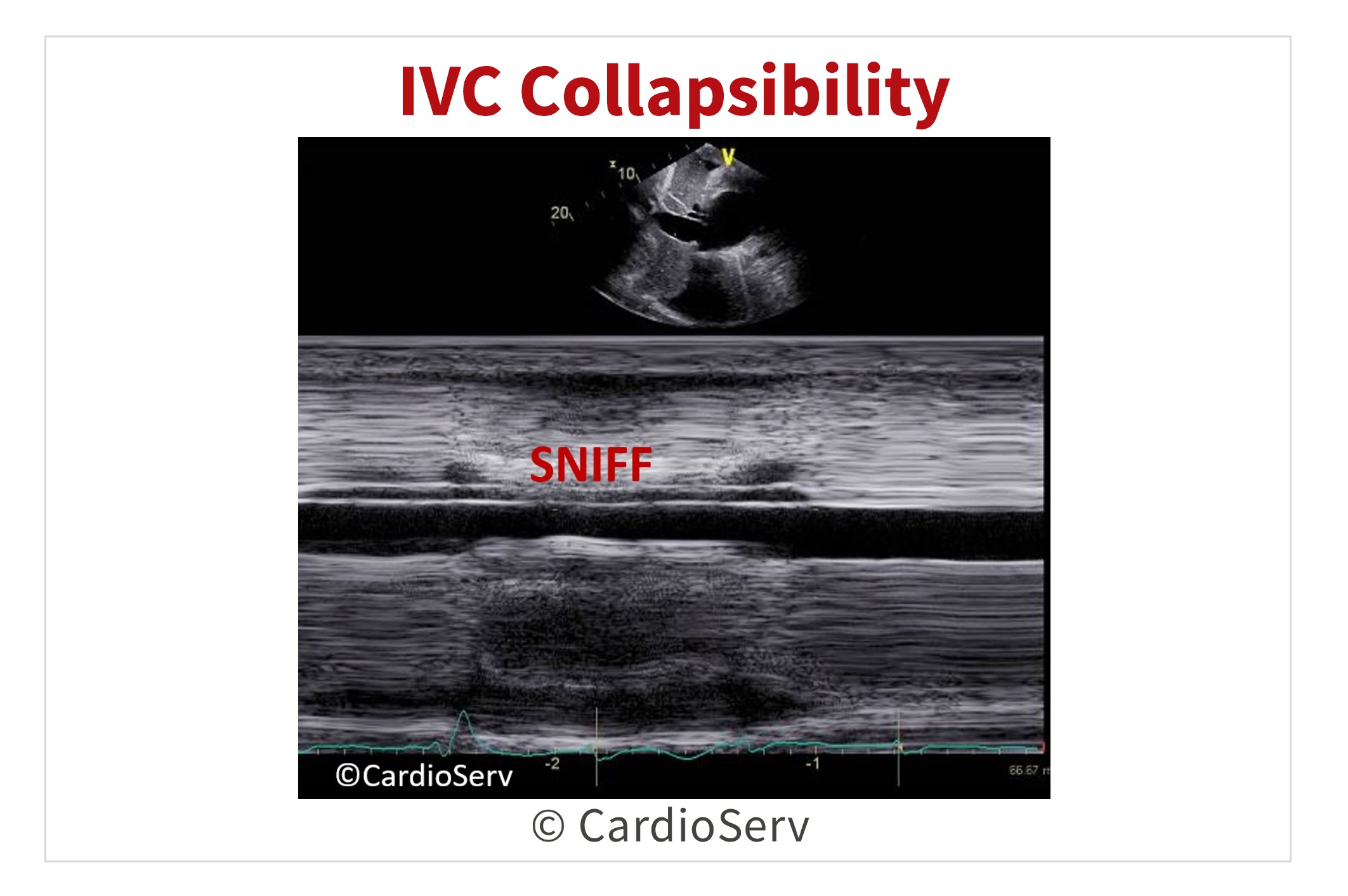 IVC Collapsibility Echo