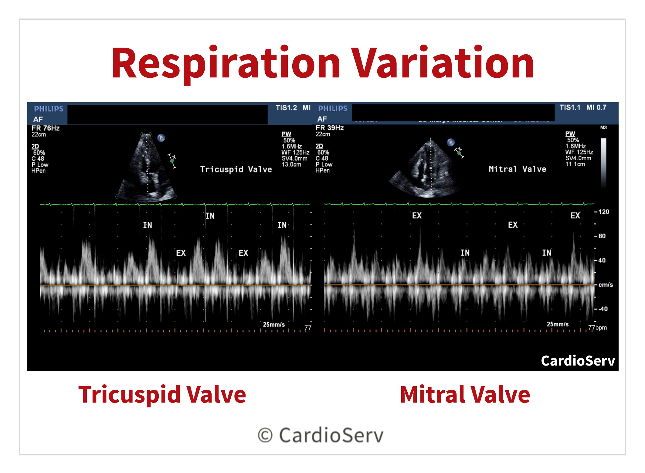 Doppler Respiration Variation Echo Pericardial Effusion