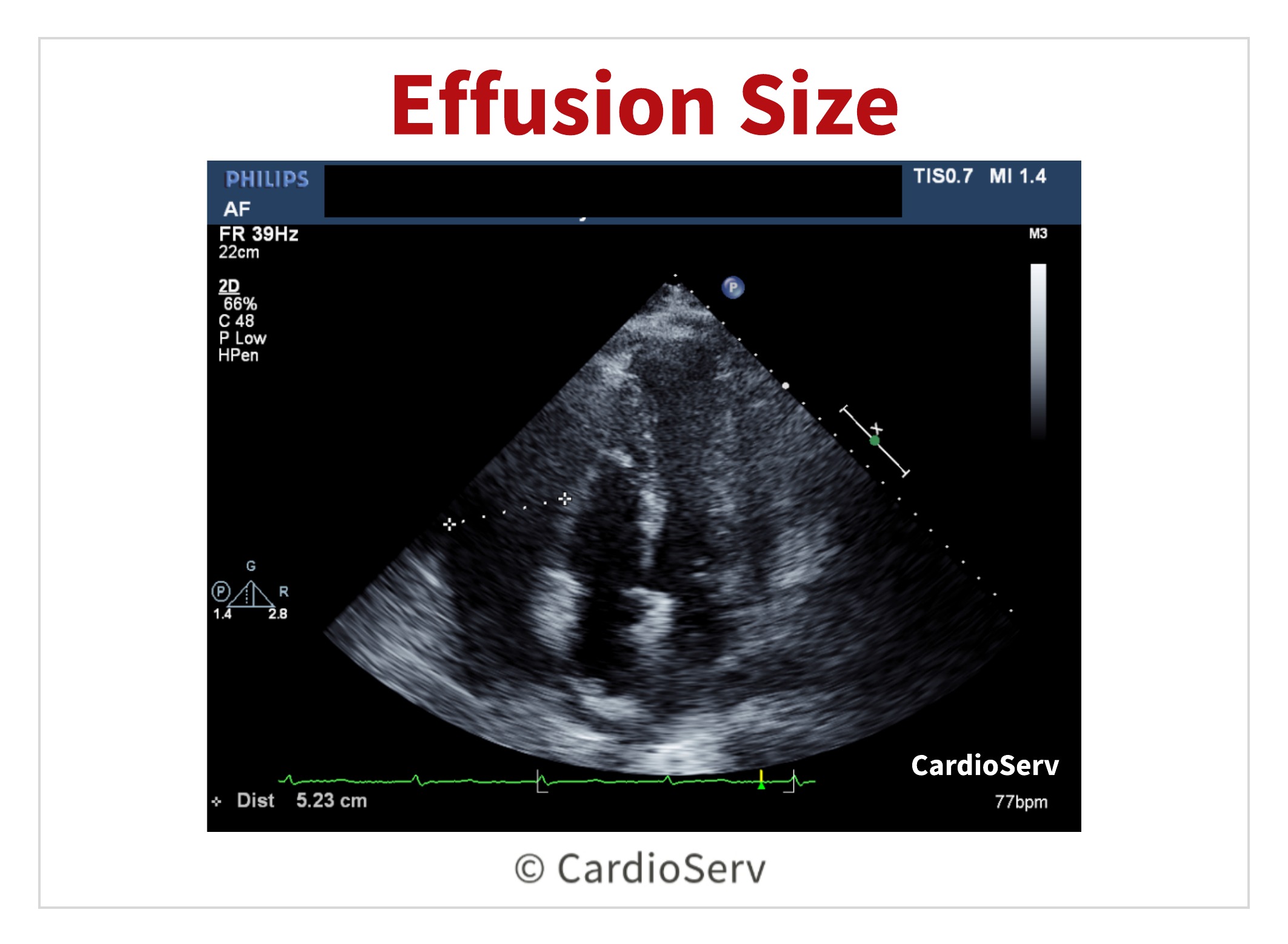 Pericardial Effusion Size Echo