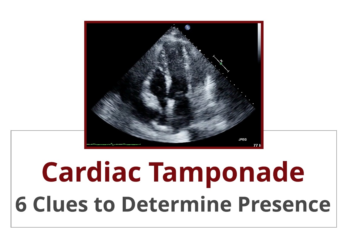 6 Clues to Determining Presence of Cardiac Tamponade