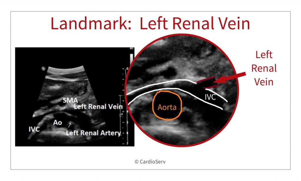 branches of aorta - renal vein