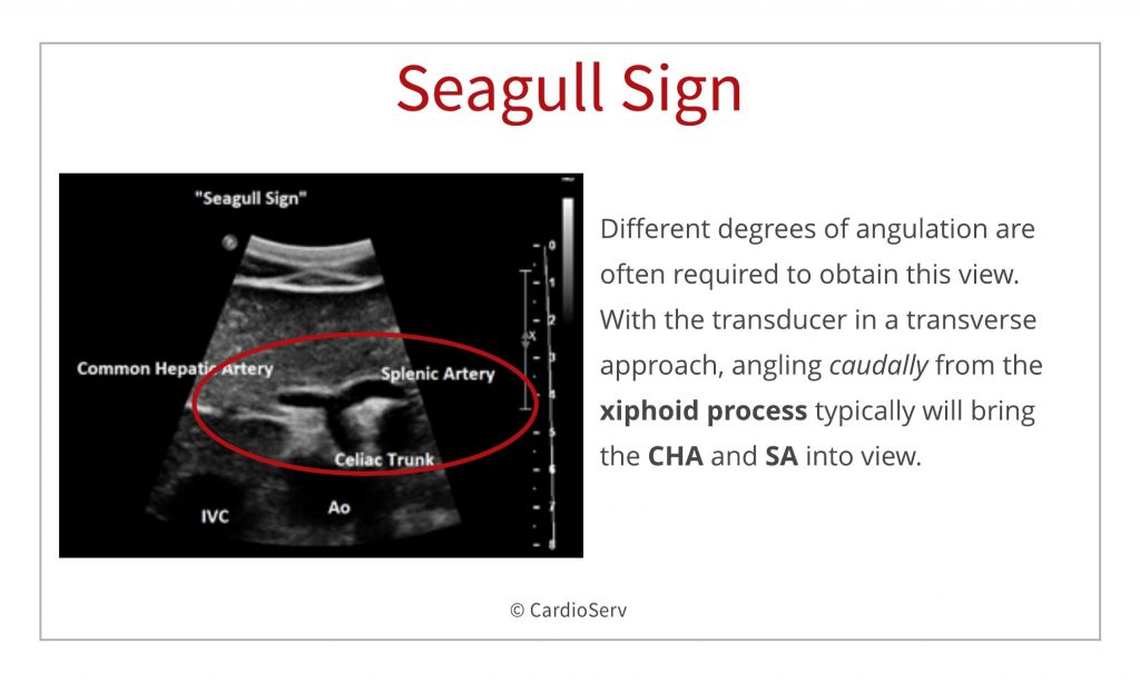 branches of the aorta - visceral ultrasound seagull sign