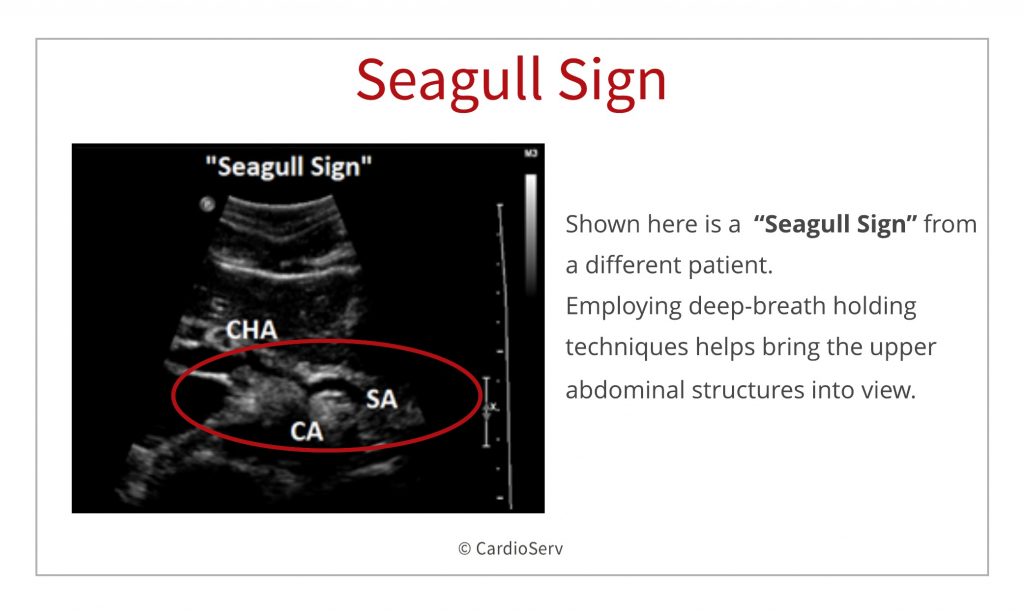 branches of the aorta -visceral ultrasound seagull sign