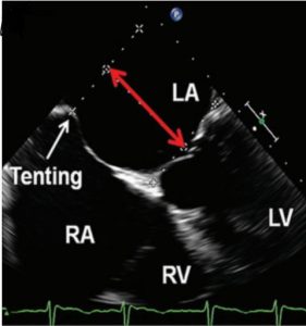 MitraClip tenting 