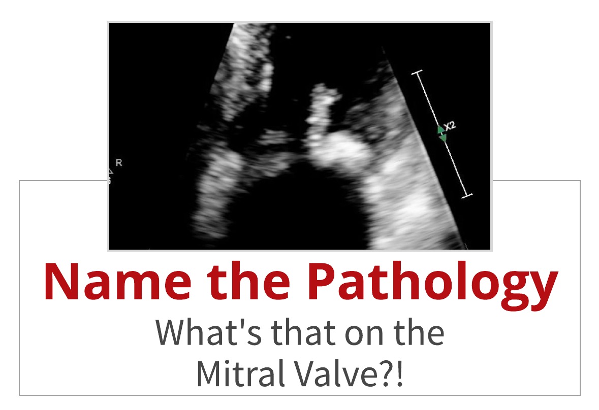 Echo Case Study:  What’s That on the Mitral Valve? Name that Pathology!