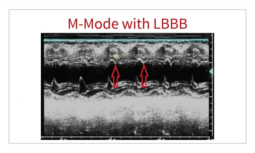 echo left bundle branch block mmode