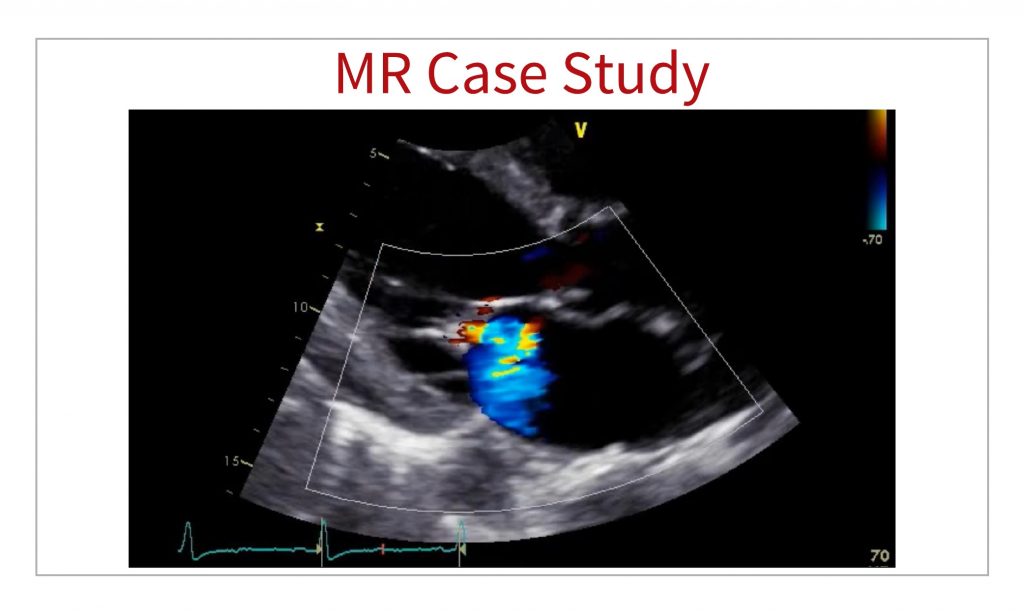 MR echo case study 