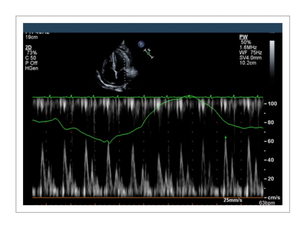 Pericardial effusion Doppler