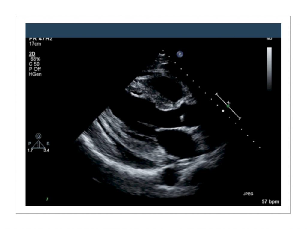 pericardial effusion parasternal long