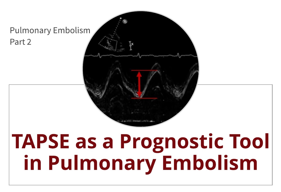 TAPSE as a Prognostic Tool in Pulmonary Embolism