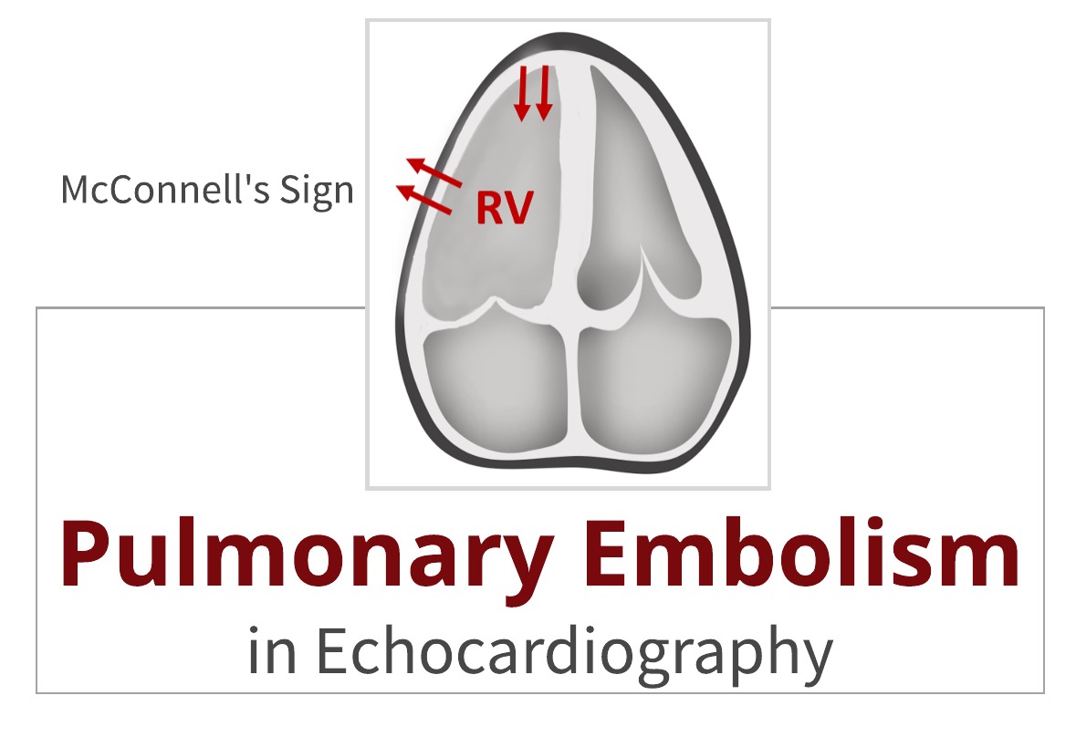 Pulmonary Embolism in Echo