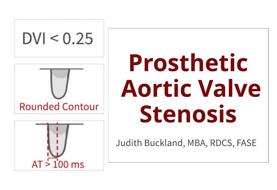 Prosthetic Aortic Valve Stenosis