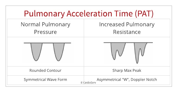 Normal v abnormal Pulmanary flow echo Doppler.  Abnormal flow has a sharp peak and a notch creating an abnormal asymmetrical waveform