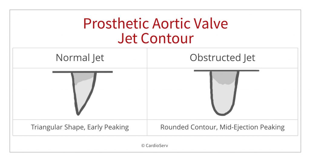 jet contour AS stenosis