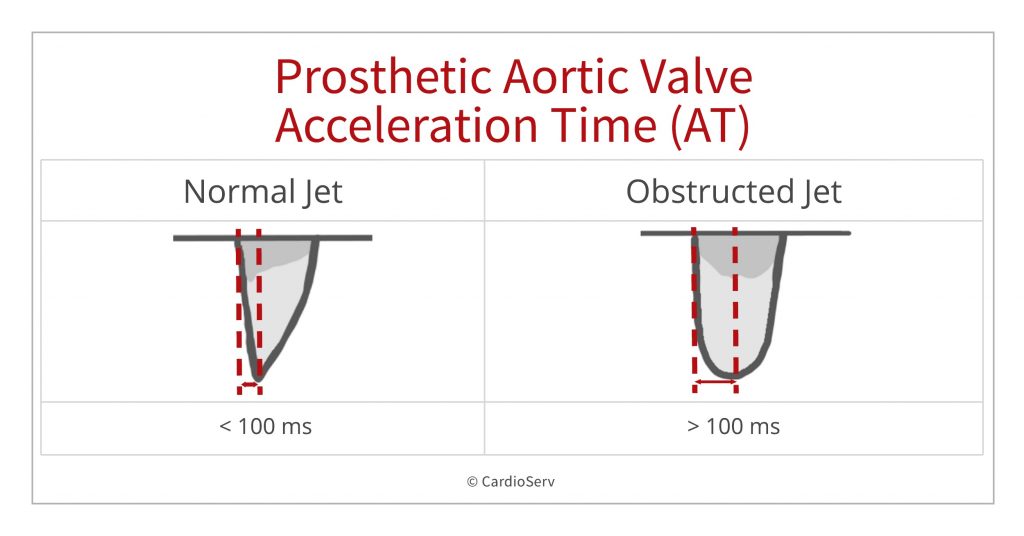 Acceleration time prosthetic aortic stenosis