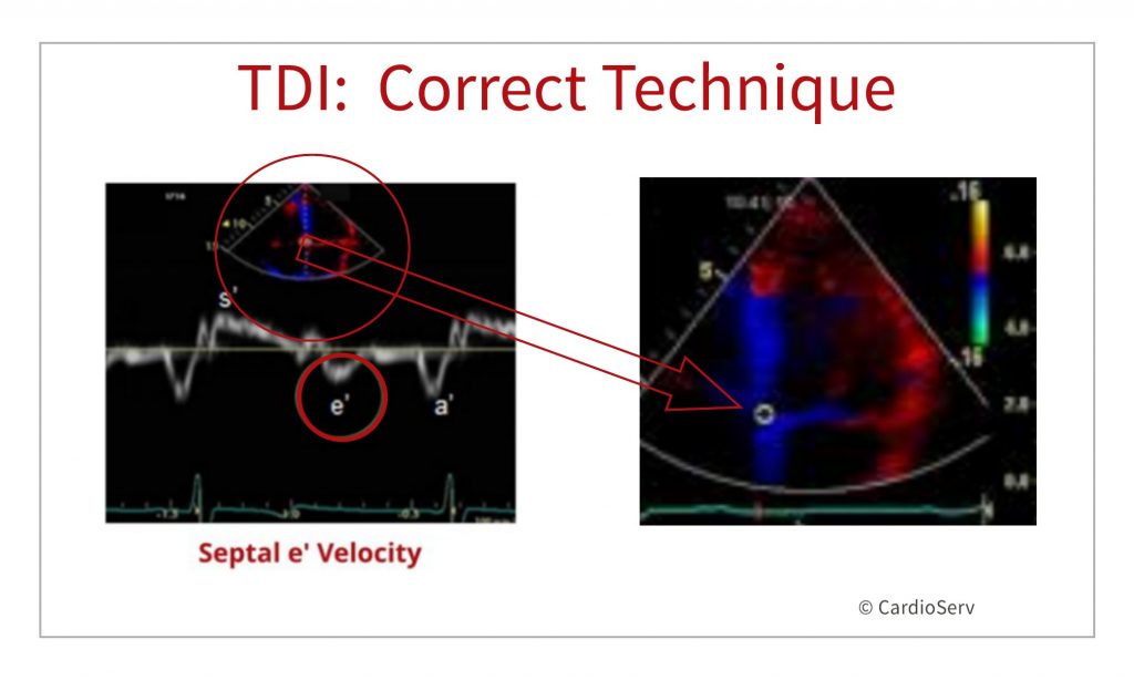 how to perform tissue Doppler diastology echocardiography